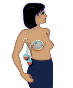 Breast drains after surgery