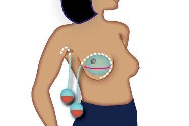 Managing Your Surgical Drains Following Breast Surgery